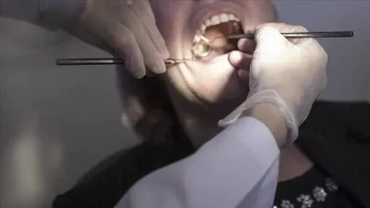 Diş eksikliği baş dönmesine neden oluyor! İmplant tedavisi ile kurtulmak mümkün mü?